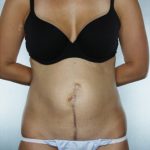 Tummy Tuck Before & After Patient #7945