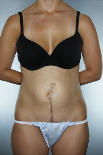 Tummy Tuck Before & After Patient #7945