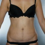 Tummy Tuck Before & After Patient #7945