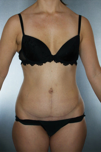 Tummy Tuck Before & After Patient #7945