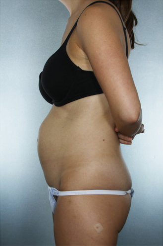 Tummy Tuck Before & After Patient #7945