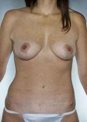 Tummy Tuck Before & After Patient #7988