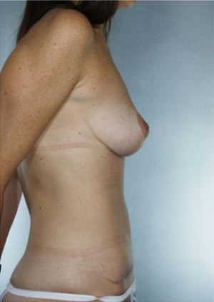 Tummy Tuck Before & After Patient #7988