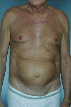 Tummy Tuck Before & After Patient #7993