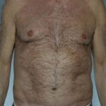 Tummy Tuck Before & After Patient #7993