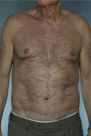 Tummy Tuck Before & After Patient #7993