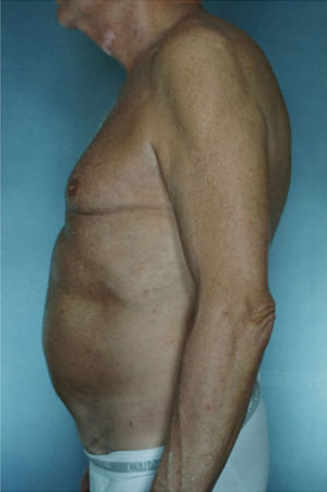 Tummy Tuck Before & After Patient #7993