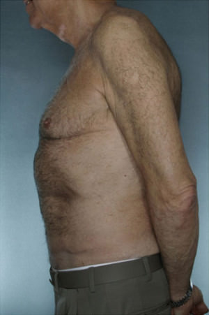 Tummy Tuck Before & After Patient #7993