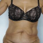 Tummy Tuck Before & After Patient #7998