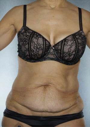 Tummy Tuck Before & After Patient #7998