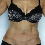 Tummy Tuck Before & After Patient #7998