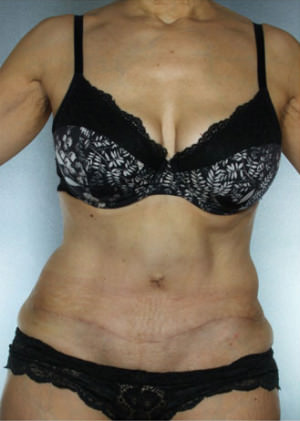 Tummy Tuck Before & After Patient #7998