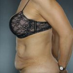 Tummy Tuck Before & After Patient #7998