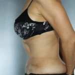 Tummy Tuck Before & After Patient #7998