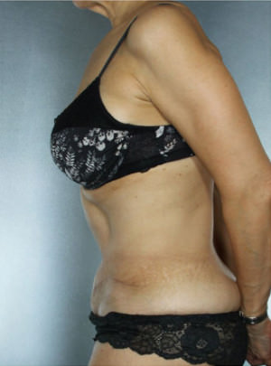 Tummy Tuck Before & After Patient #7998