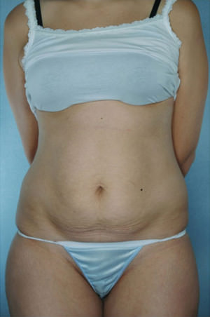 Tummy Tuck Before & After Patient #8003