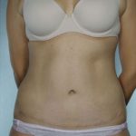 Tummy Tuck Before & After Patient #8003