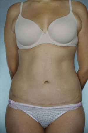 Tummy Tuck Before & After Patient #8003