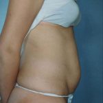 Tummy Tuck Before & After Patient #8003