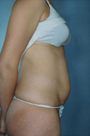 Tummy Tuck Before & After Patient #8003