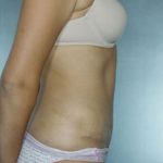 Tummy Tuck Before & After Patient #8003
