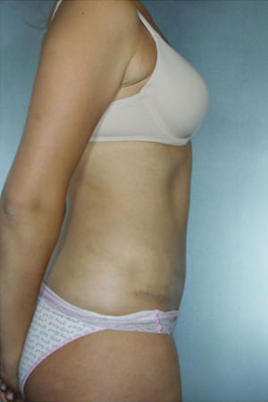 Tummy Tuck Before & After Patient #8003