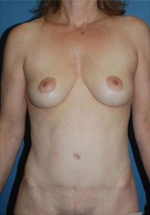 Tummy Tuck Before & After Patient #8008