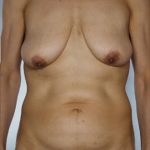 Tummy Tuck Before & After Patient #8013