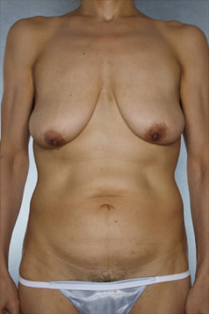 Tummy Tuck Before & After Patient #8013