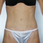 Tummy Tuck Before & After Patient #8018