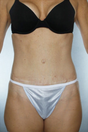 Tummy Tuck Before & After Patient #8018