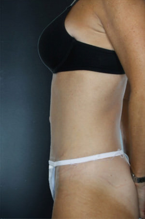 Tummy Tuck Before & After Patient #8018