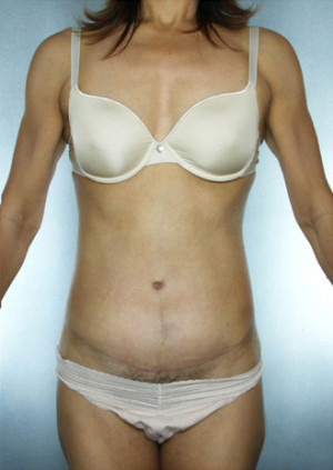 Tummy Tuck Before & After Patient #8023