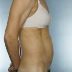 Tummy Tuck Before & After Patient #8023