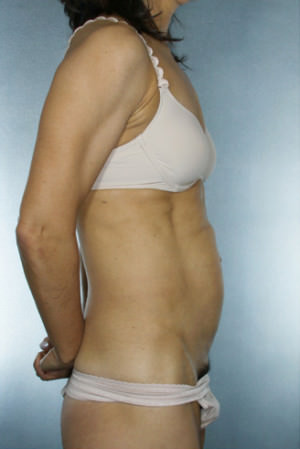 Tummy Tuck Before & After Patient #8023