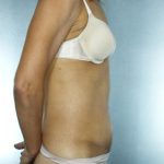Tummy Tuck Before & After Patient #8023