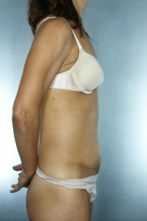 Tummy Tuck Before & After Patient #8023