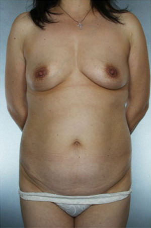 Tummy Tuck Before & After Patient #8028