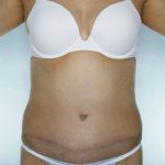 Tummy Tuck Before & After Patient #8028