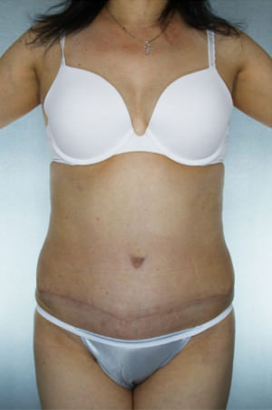 Tummy Tuck Before & After Patient #8028
