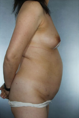 Tummy Tuck Before & After Patient #8028