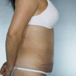 Tummy Tuck Before & After Patient #8028