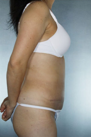 Tummy Tuck Before & After Patient #8028