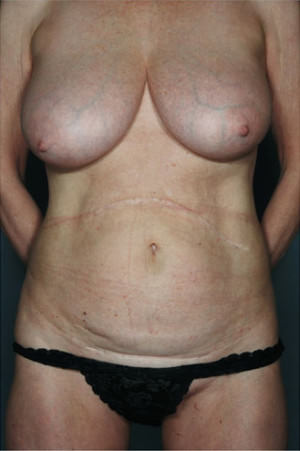 Tummy Tuck Before & After Patient #8043