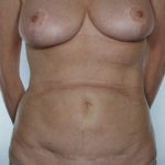 Tummy Tuck Before & After Patient #8043