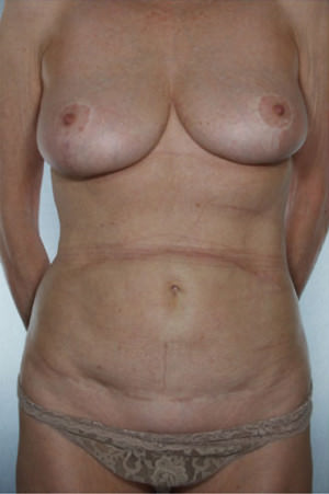 Tummy Tuck Before & After Patient #8043