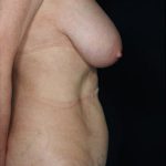 Tummy Tuck Before & After Patient #8043