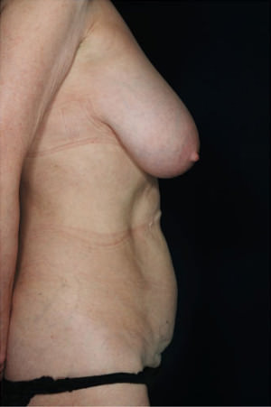 Tummy Tuck Before & After Patient #8043