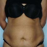 Tummy Tuck Before & After Patient #8048