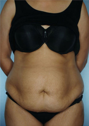 Tummy Tuck Before & After Patient #8048